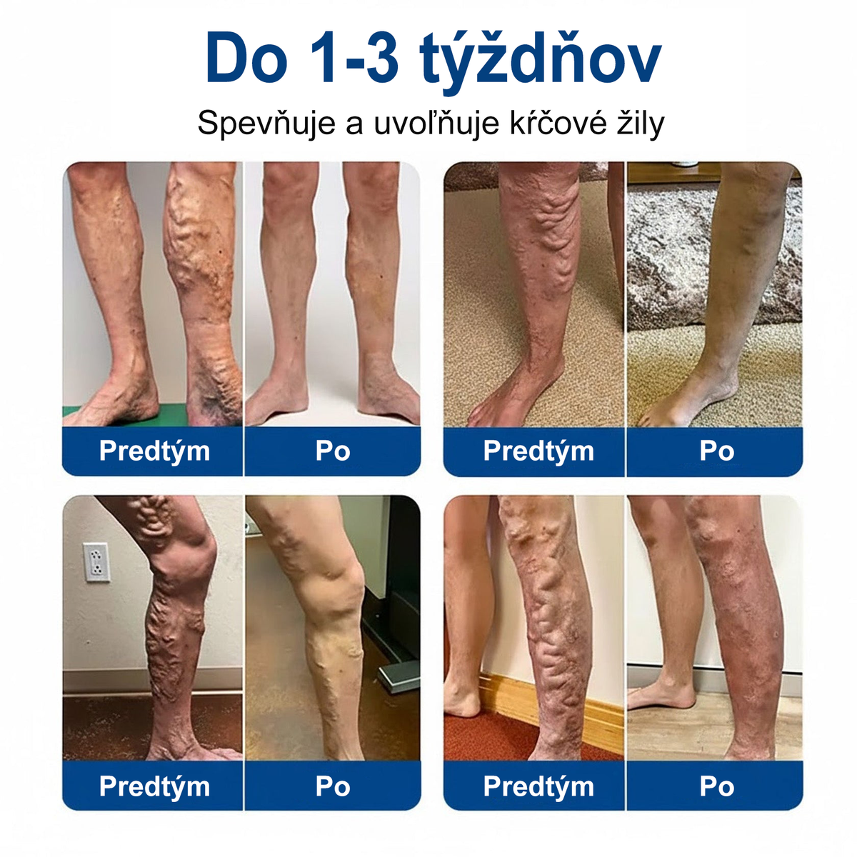 👨‍⚕️✅ Medistart® VeinRepair – mikroihličková ošetrujúca náplasť ⚡ Okamžitá úľava, dlhotrvajúci výsledok