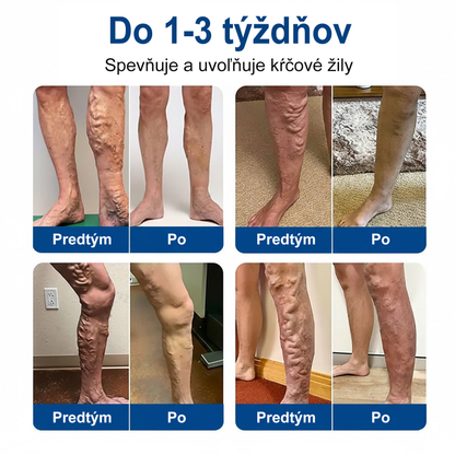 👨‍⚕️✅ Medistart® VeinRepair – mikroihličková ošetrujúca náplasť ⚡ Okamžitá úľava, dlhotrvajúci výsledok